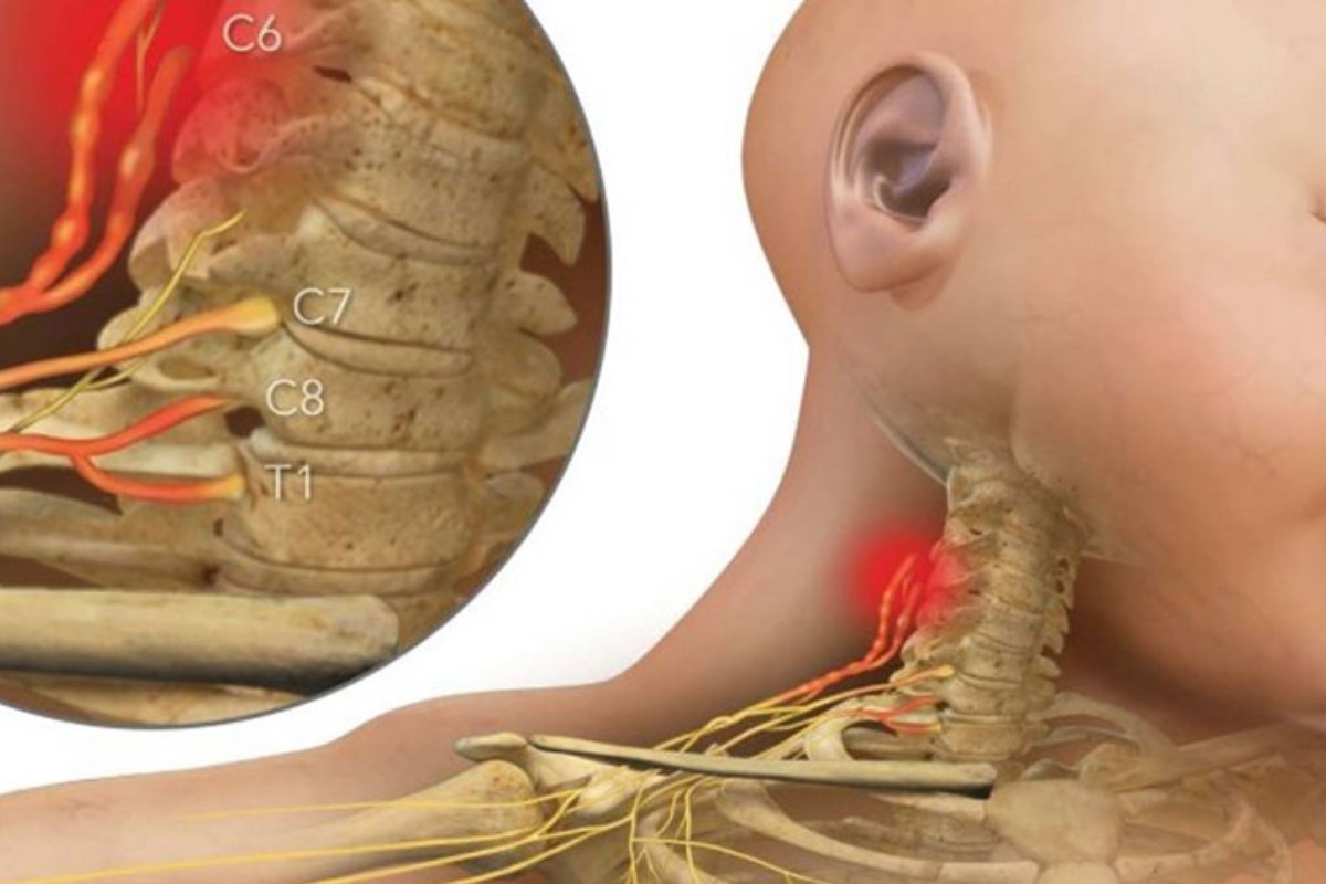 تشخیص فلج ارب