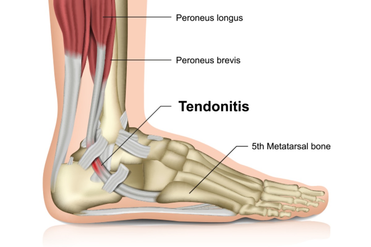 تعریف تاندونیت