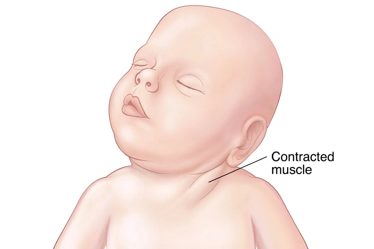 تورتیکولی یا کجی گردن