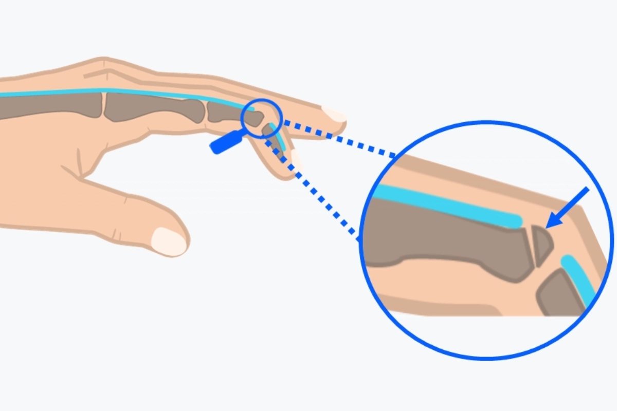 علائم هشداردهنده در کشیدگی تاندون انگشت دست