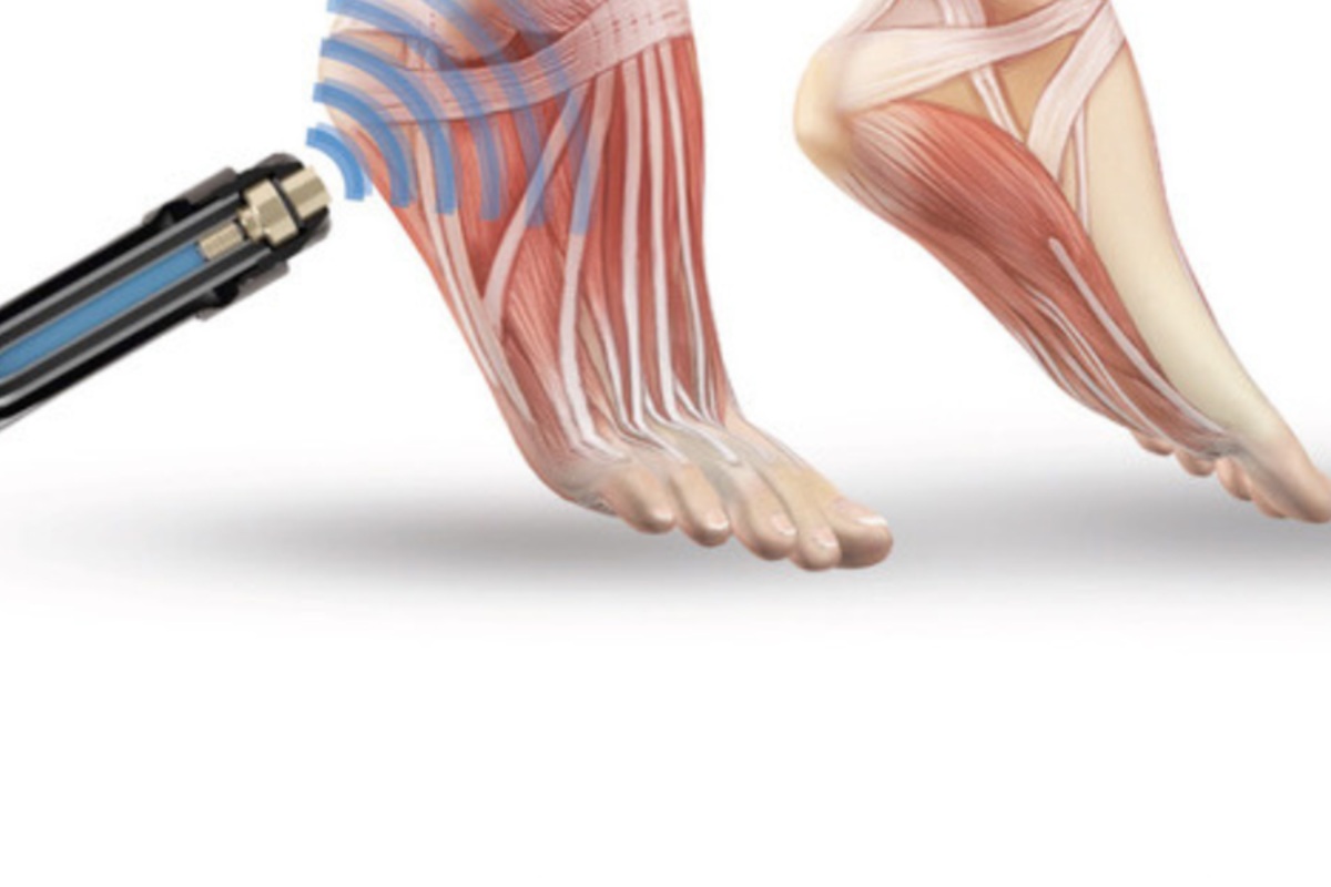 عوارض جانبی شاک ویو تراپی