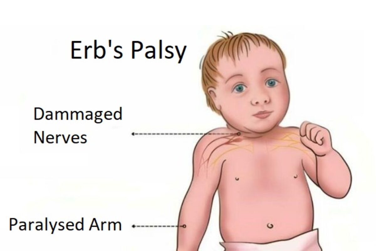 فلج ارب چیست