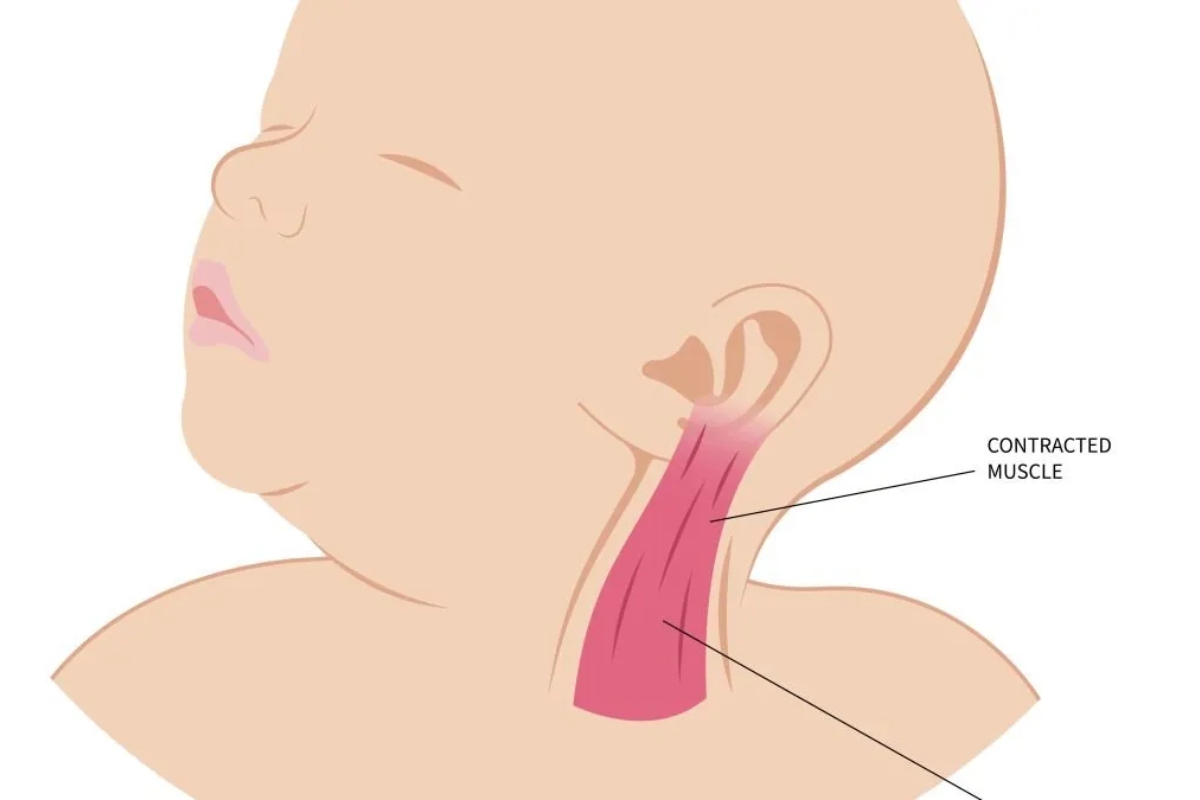 نشانه های کجی گردن