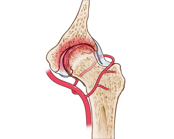 نکروز سر استخوان ران چیست