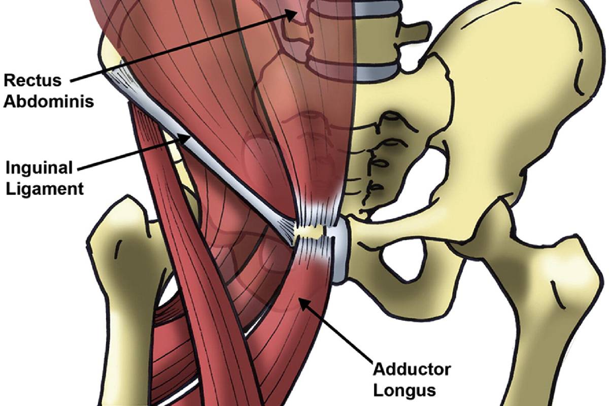 فتق اینگوینال