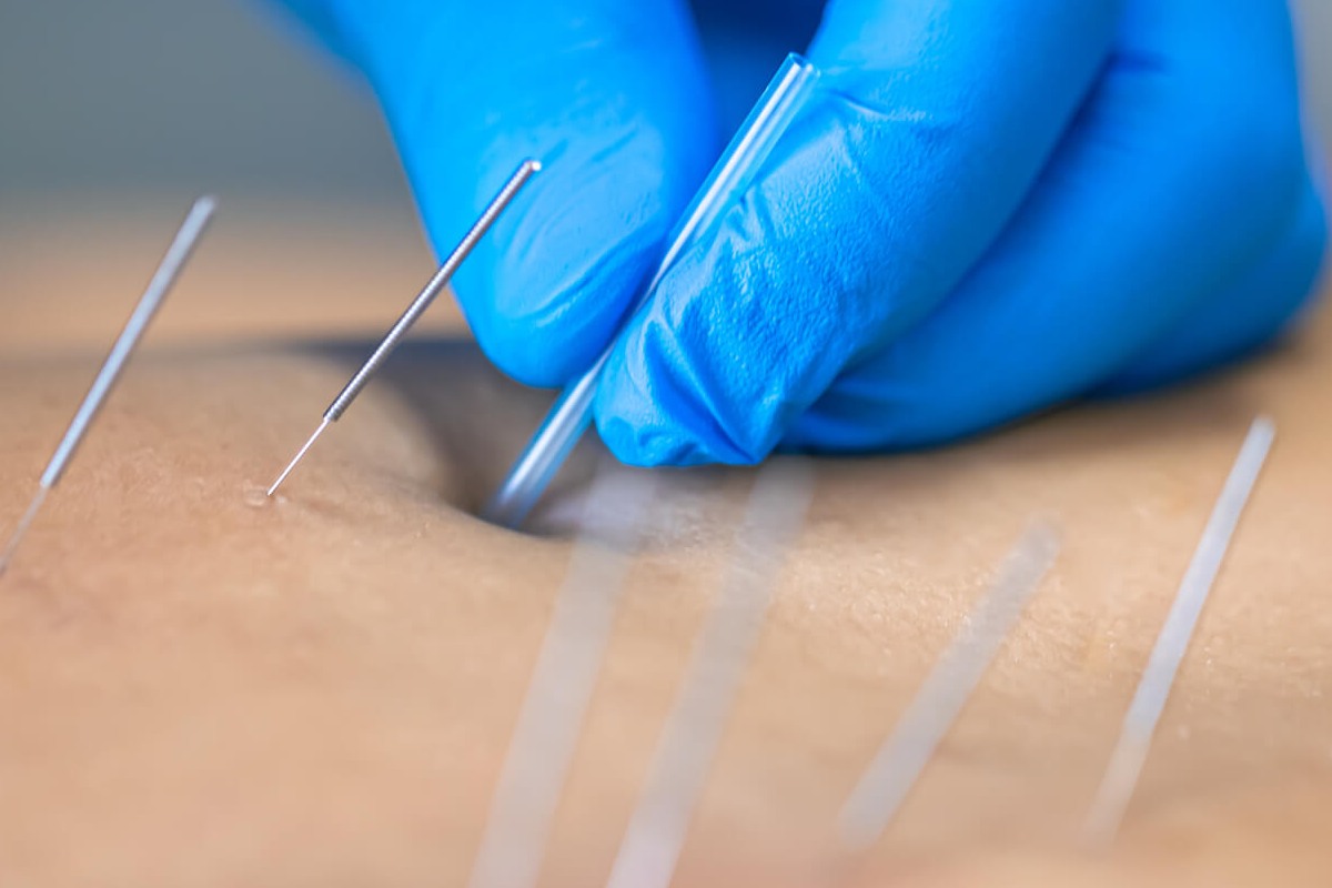 مراقبت بعد از درای نیدلینگ