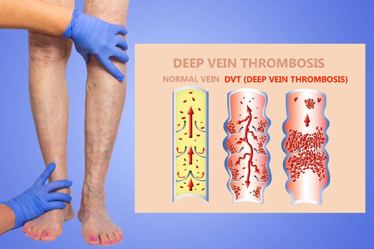 ترومبوز ورید عمقی (DVT)