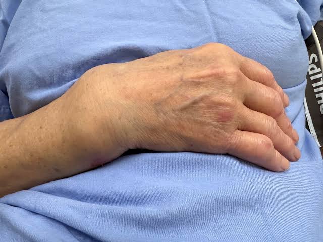 علائم شکستگی مچ دست